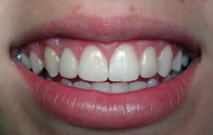 One week later-temps