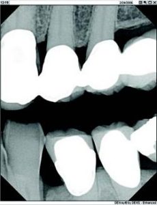Figure 1-See more tooth length with vertical bitewings