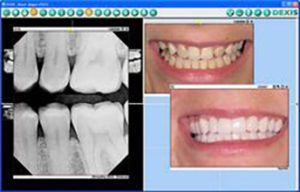 Figure 4-Precision and accuracy is available ini 2-D implant software