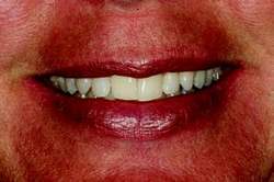 Figure 1-PreOp Smile