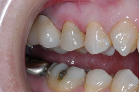 Figure 4: Preparation completed, scanned with laser scanner,and designed using E4D DentaLogic software.