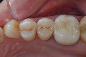 Figure 5: Same-day restoration completed usingthe E4D Dentist System. IPS Empress restorationcharacterized and glazed for a complete restorative solution.