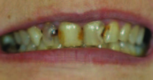 43 year old female patient presented with a chief complaint of “I haven’t been to the dentist in years. My teeth hurt and I never smile anymore.” Her anterior treatment plan consisted of eight restorations from #5 to #12 with necessary endodontic treatment.