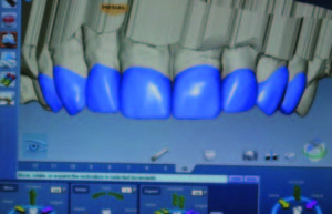 Completed design. I used the Clone design technique to mimic the patient’s approved provisionals thereby guaranteeing proper esthetics and occlusion. All interproximal contacts can also be verified simultaneously.