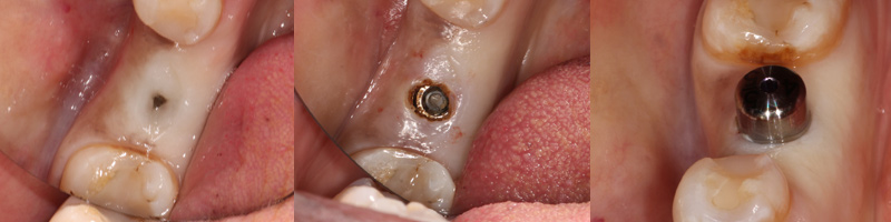 Precise LTM laser procedure