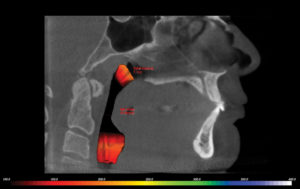 3D image of i-CAT scan
