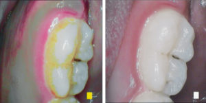 SoproCARE in Perio mode (left) and Daylight mode (right)