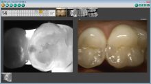 During capture, DEXIS CariVu images are automatically compared with X-rays and photos.