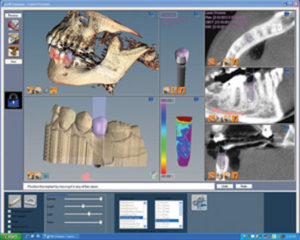 Figure 4. All on one screen: shown here as the final plan for tooth 20.