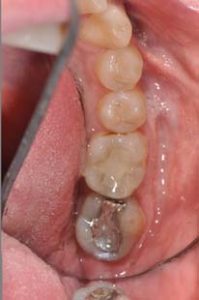 Figure 1: Patient presented with recurrent decay around an amalgam filling