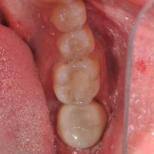 Figure 2: The completed restoration was seated with no adjustments necessary