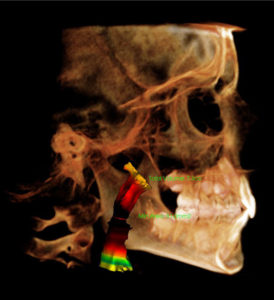 An i-CAT scan in Tx STUDIO displays the airway in 3D along with color-coded measurement values