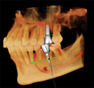 Implant planning with i-CAT Precise data in Tx Studio