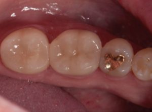 Lab-quality chairside in one visit with Planmeca FIT.