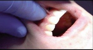 Buccal Frenom Before