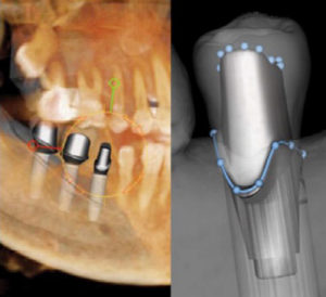 Removing ameloblastomas