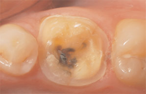 Case 1. Figure 2. View of the preparation design, which was kept above the gingival margin to enable cleanability and conservation of natural tooth structure.