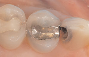 Case 2. Figure 1. Preoperative view of the quadrant showing decay in the canine and a defective amalgam restoration in the upper first premolar.