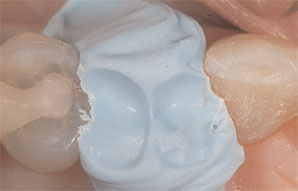 Case 2. Figure 3. A small amount of bite registration material was carefully applied to the prepared tooth.
