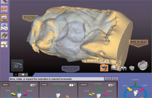 Case 2. Figure 4. This screen shot of the DentaLogic™ software helps to illustrate the design progress. A translucent view of the bite strip that was imaged during the scanning process has been superimposed and automatically aligned by the software. The location of the opposing teeth is clearly visible so that the occlusion can be manually designed, or the automatic design tools can be used to refine the bite relationship of the proposed restoration.