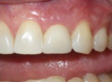 #10 Screw-retained Emax crown with great emergence profile and papilla development done with Planmeca FIT.