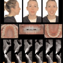 Figure 10: A 21-year-old pre-orthodontic patient with an anterior open bite, long anterior face height, short posterior face height, and steep mandibular plane. The transaxial images of the anterior region of the jaws show the anterior open bite, axial inclination of the incisor teeth and thin paucity of supporting alveolar bone. Please note the narrow labiolingual dimensions of the alveolar bone apical to the roots of the teeth. The images were acquired with a NewTom 9000 using a 9-inch FOV and 0.29-mm cubic voxel size.