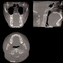 Figure 2a: A 13-cm field of view (FOV) CBCT scan was acquired using the iCAT and displayed in a multiplaner reformat (MPR) mode showing he coronal, sagittal, and axial views.