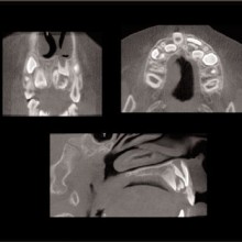 Figure 2b: A 6-cm FOV CBCT was acquired of the maxilla using the iCAT. The MPR's format was utilized to triangulate and display impacted tooth #9 and two associated supernumerary teeth.