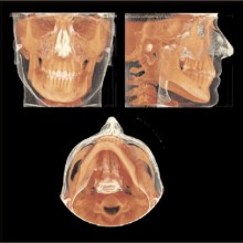 Figure 4: A 13-cm FOV CBCT was acquired with the iCAT, and displayed using a volume rendering algorithm (VR). The VR rendering of the skin and subjacent skeleton was accomplished with inVivoDental software.