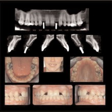 Figure 5: These images are for a 17-year-old female with congenitally missing maxillary lateral incisor teeth. The sites are being evaluated for feasibility of implant placement with the aid of a radiographic stent. The clinical photographs show the edentulous sites and the CBCT scans show metallic stent markers. The stent markers have been placed to simulate the proposed drill path that was determined by clinical exam. The CBCT images can be used to determine if proposed drill path (implant trajectory) will conform to the jaw boundaries. The maxilla was scanned with an iCAT CBCT utilizing a 6-cm FOV and a 0.2-mm cubic voxel size.