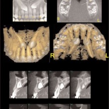 Figure 9: This series of images shows impacted maxillary cuspid teeth. The CBCT scan was used to localize and visualize these teeth and the adjacent anatomy. These images can be used to plan surgical access and develop a strategy for the traction mechanics required to mobilize these teeth into their proper alignment with the maxillary arch. All images were cross-referenced with each other. The maxilla was scanned using the iCAT CBCT with a 6-cm FOV and 0.2-mm cubic voxel size. The images were rendered with ISI's DVR and native software. (Images courtesy of Amnon Leitner, Nahariya, Israel)