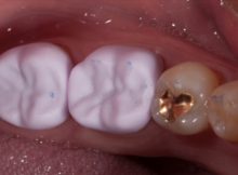 Multiple restorations in a single visit boost productivity. Emax crowns tried prior to sintering and glazing can show off the occlusal anatomy and contacts.