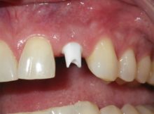 #10 Zirconia implant abutment.